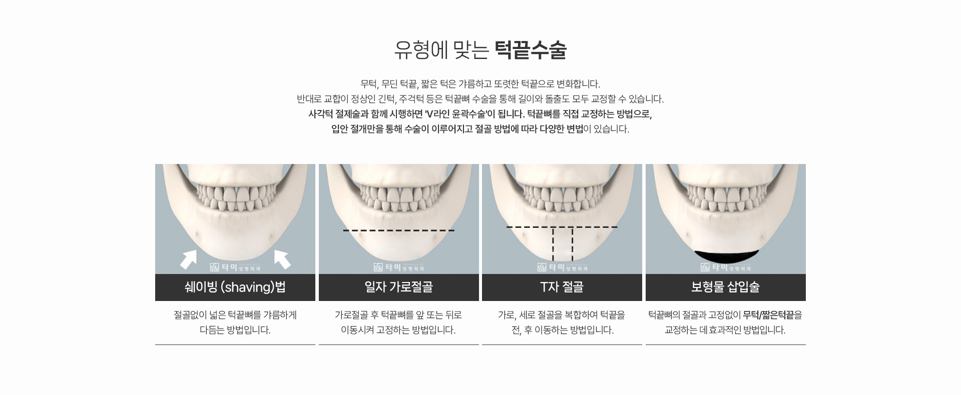 얼굴성형