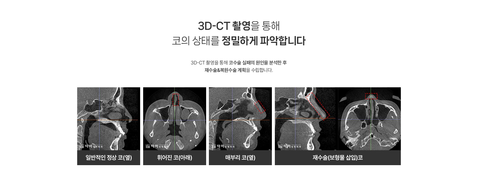 코성형