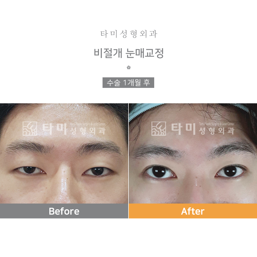 [인천 실 리프팅] 비나스코 솔직 후기(부종, 통증, 마취) 3