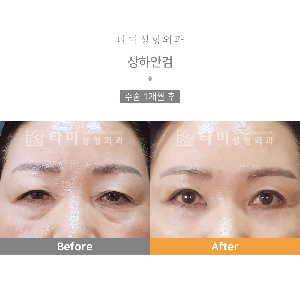 [인천 실 리프팅] 비나스코 솔직 후기(부종, 통증, 마취) 4